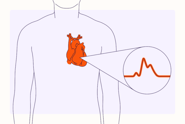 Understanding Cardiac Arrest Heart Attack And Stroke